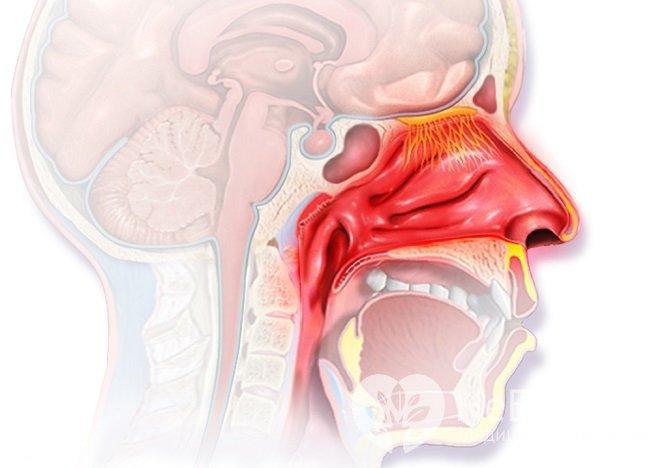 Назофарингитом называется воспаление слизистой оболочки носоглотки