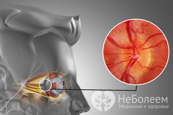 Воспаление оптического нерва приводит к нарушениям зрения