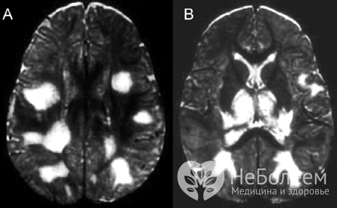 При ОРЭМ в головном и спинном мозге образуются участки демиелинизации