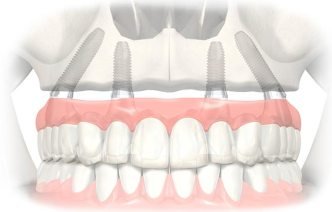 All-on-4 имплантация при полном отсутствии зубов