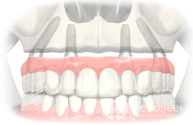 All-on-4 имплантация: преимущества, этапы