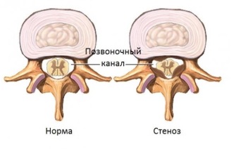 Что нельзя делать после операции на позвоночнике