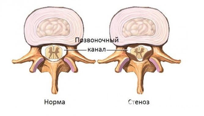 Стеноз позвоночного канала