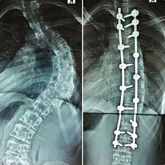 Хирургическая коррекция сколиоза