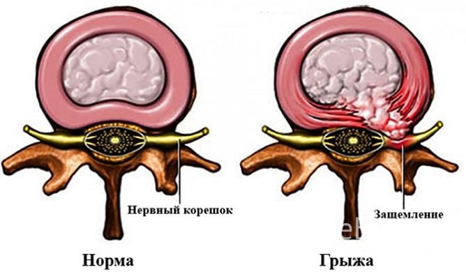 Грыжа межпозвоночного диска