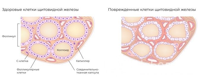 Медикаментозное лечение гипофункции щитовидной железы