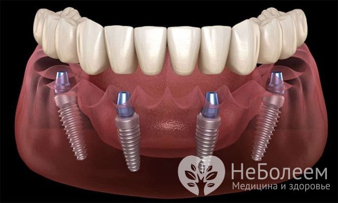 Имплантация зубов All-on-4: основные преимущества 