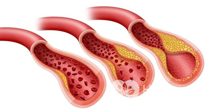 Что такое атеросклероз?
