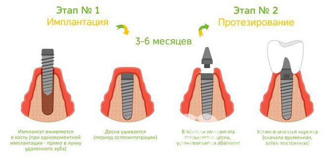 двухэтапная имплантация