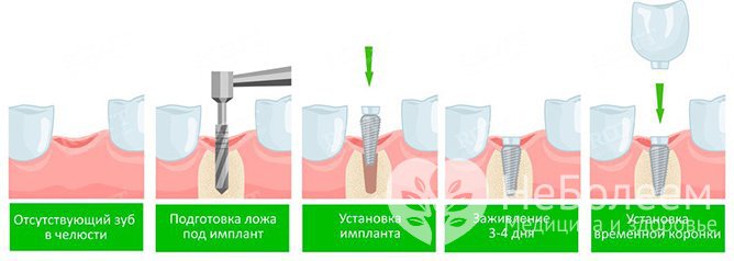 одноэтапная имплантация