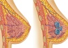 Признаки мастопатии и лечение — опыт врача-онколога