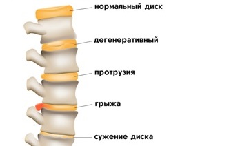 Признаки остеохондроза. Пандемия, которую мы не замечаем.