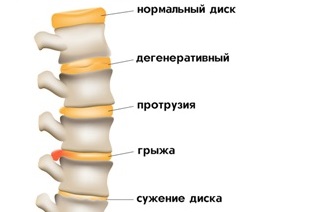 Признаки остеохондроза. Пандемия, которую мы не замечаем.