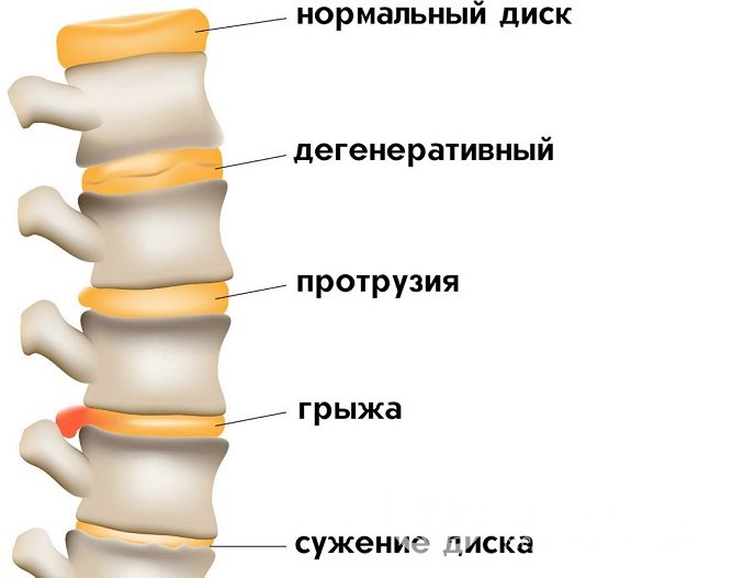 Признаки остеохондроза