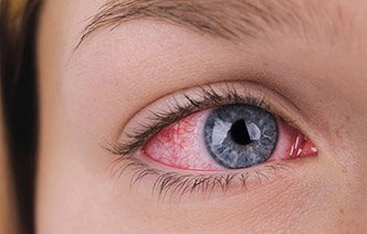 Топ 10 симптомов повреждения глаз