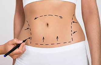 Что такое липосакция и какие результаты от нее ожидать