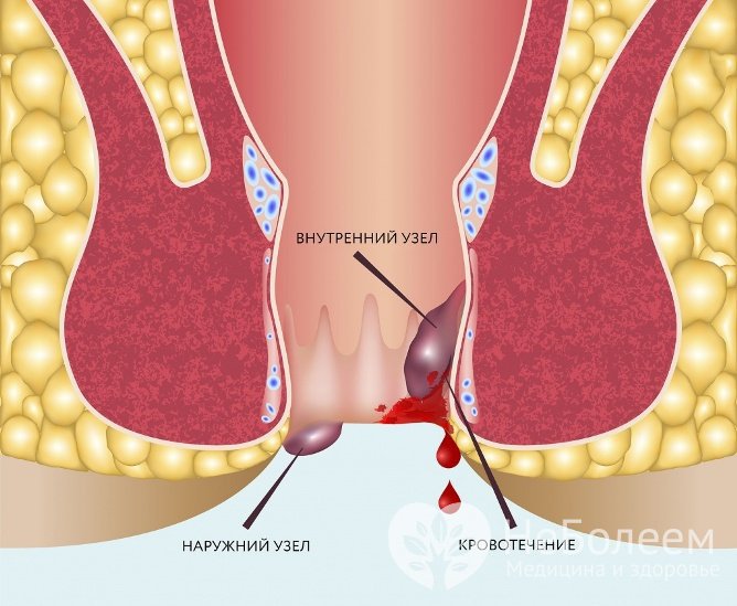 Внутренний геморрой: причины, симптомы