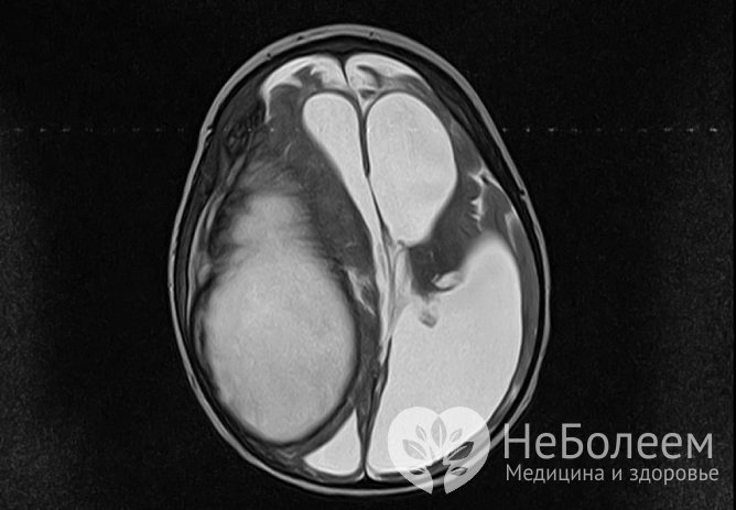 Абсцесс мозга имеет воспалительное или посттравматическое происхождение