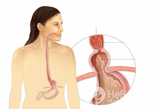 Хиатальная, или аксиальная грыжа – одно из распространенных заболеваний пищеварительного тракта