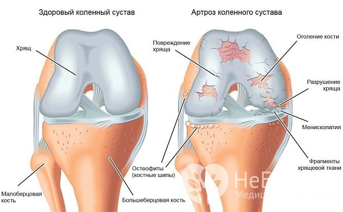 По мере прогрессирования заболевания происходит изменение тканей хряща