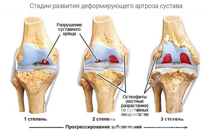 В результате разрастания остеофитов происходит ограничение амплитуды движений