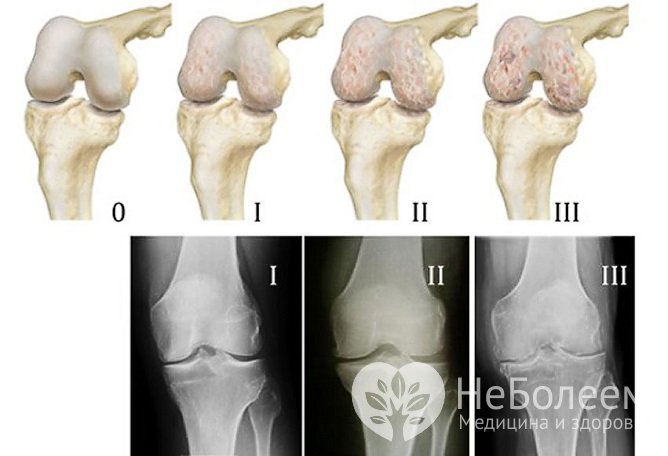 Причины постепенного разрушения сочленений могут быть различными