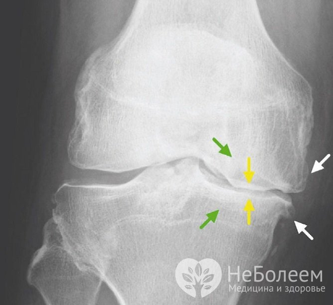 Для уточнения диагноза назначается рентгенография