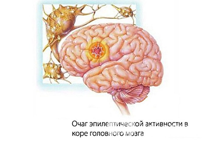 О фокальной (очаговой) эпилепсии говорят, когда удается выявить четкий очаг эпиактивности