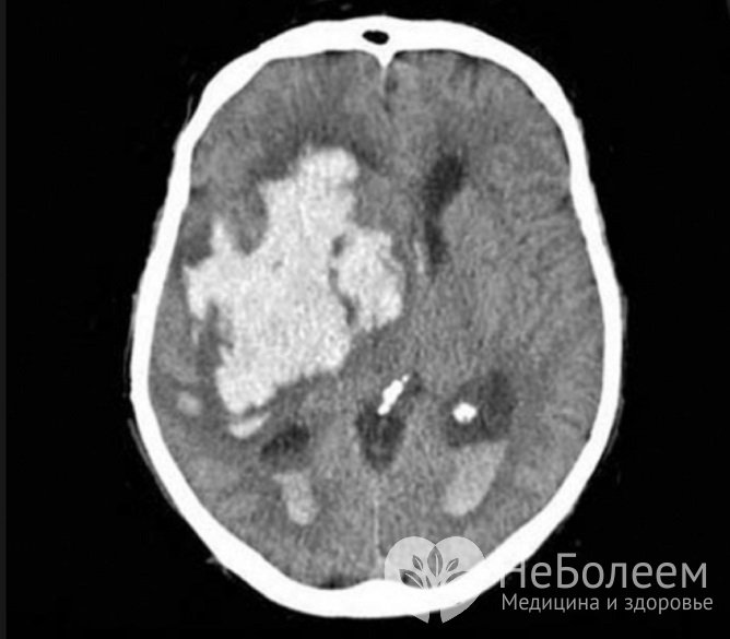 При внутримозговой форме гематомы кровь скапливается в веществе головного мозга