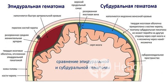 Различают два вида гематом на голове