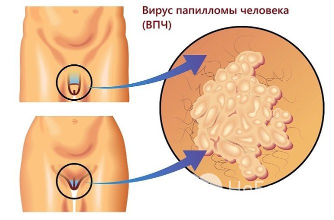 Генитальные бородавки