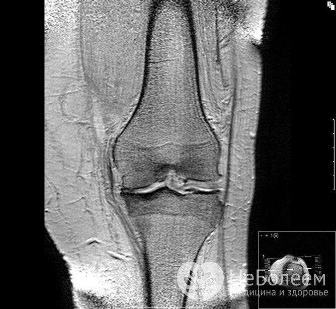 В основе заболевания лежит постепенное разрушение хрящевой ткани