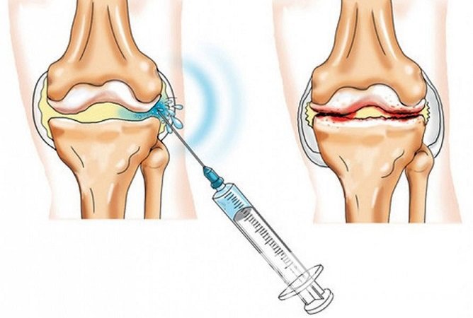 Кортикостероиды могут вводиться непосредственно в полость сустава