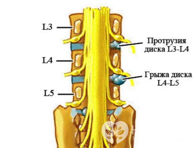 Грыжа диска L5-S1