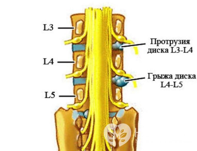 На данный сегмент позвоночника приходится наибольшая нагрузка, поэтому грыжи здесь возникают чаще всего