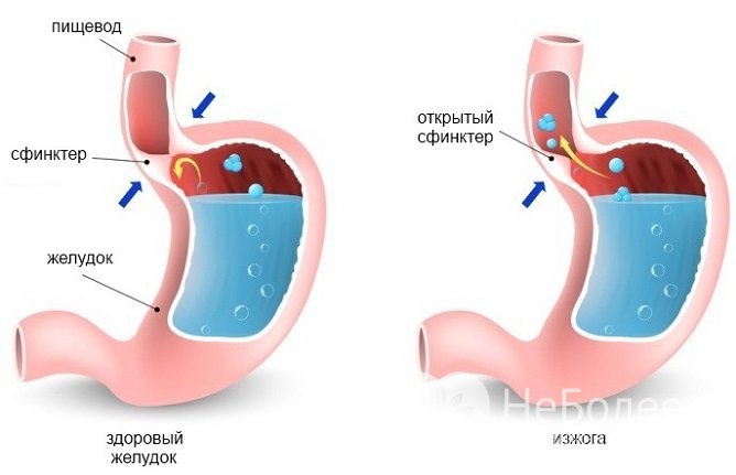 Изжога возникает из-за заброса содержимого желудка в пищевод