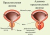 Эффективные препараты и лекарства для лечения гиперплазии предстательной железы (аденомы простаты) без операции