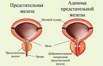 Эффективные препараты и лекарства для лечения гиперплазии предстательной железы (аденомы простаты) без операции