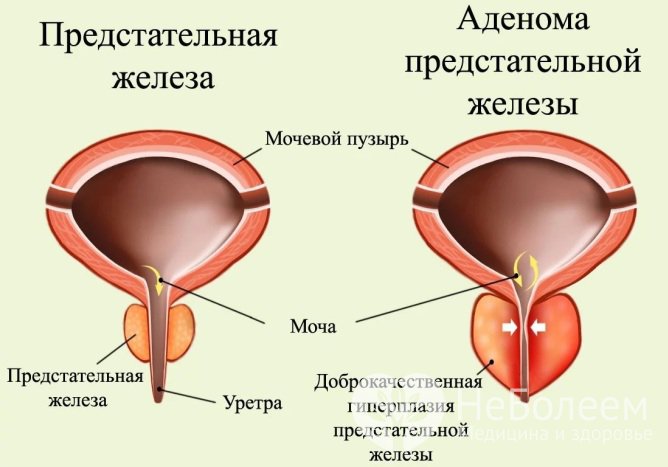 Гиперплазия предстательной железы: варианты лечения