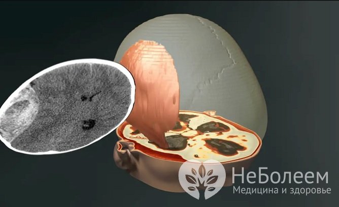 Выраженность симптомов зависит от степени тяжести травмы