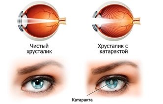 Катаракта: причины, симптомы и методы лечения