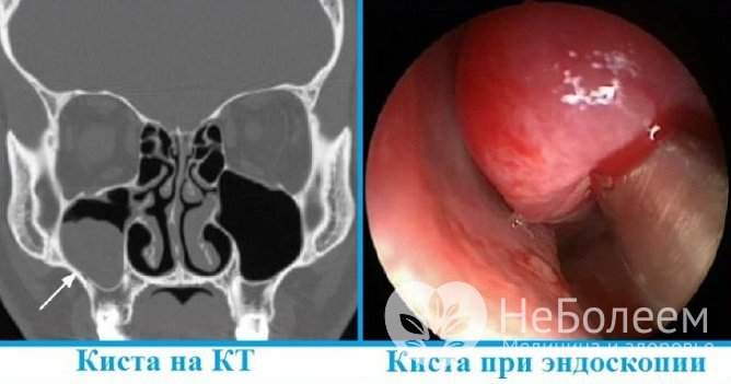 Киста гайморовой пазухи удаляется хирургически в том случае, если она склонна к росту и развитию осложнений