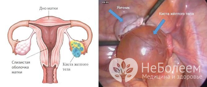 Киста яичника на фото выглядит как округлое новообразование