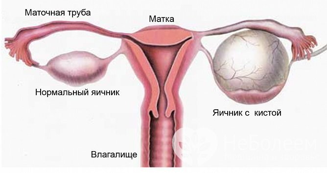 Киста левого яичника