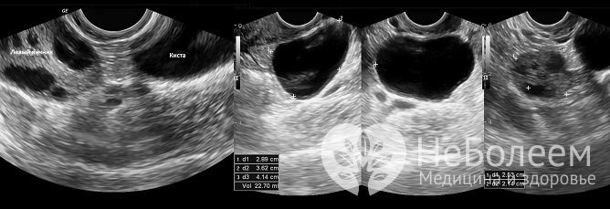 Основной метод диагностики овариальных кист – ультразвуковое исследование