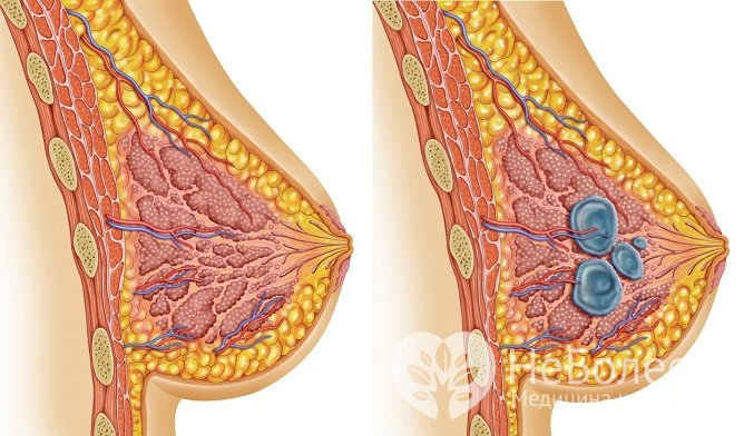Киста молочной железы является одним из проявлений фиброзно-кистозной мастопатии