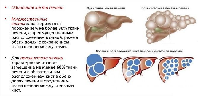 Печеночные кисты могут значительно разрастаться в ткани органа