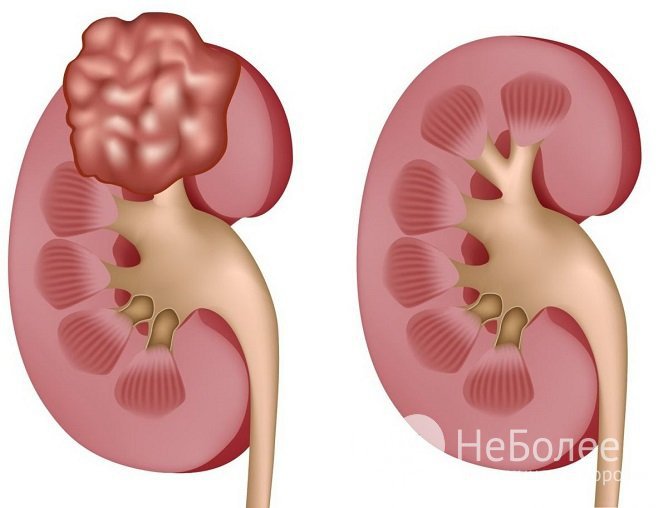 Киста почки может ничем не проявляться, но также может приводить и к серьезным нарушениям почечной функции