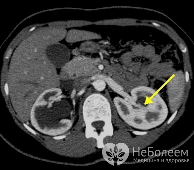 Компьютерная томография - один из методов диагностики почечных кист
