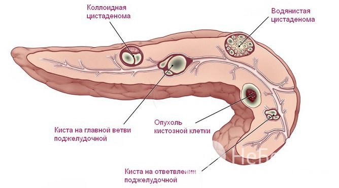 От типа панкреатической кисты зависит подход к ее лечению и прогноз